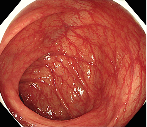 大腸の内視鏡検査