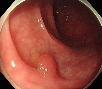 凸凹の少ないポリープ