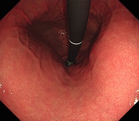 内視鏡で見る胃